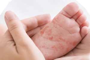 Understanding the difference : Cow’s Milk Allergy vs Lactose Intolerance