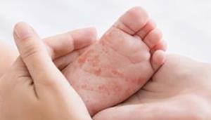 Understanding the difference : Cow’s Milk Allergy vs Lactose Intolerance